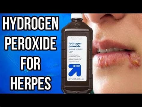 However, not all grades of the substance are the same. . Herpes and peroxide